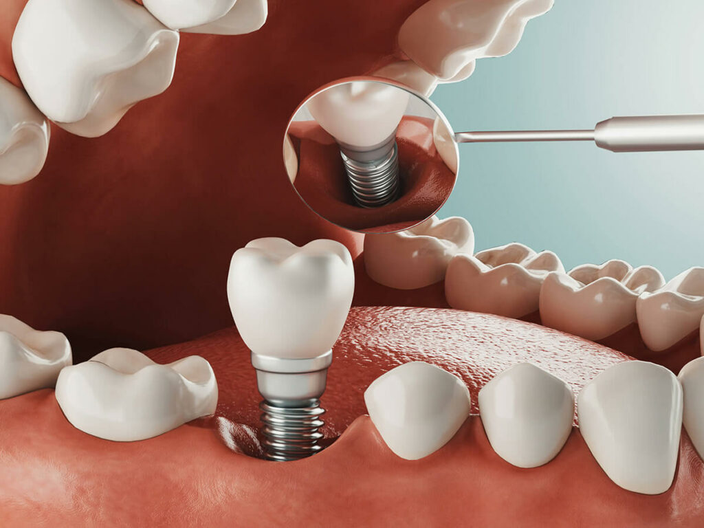 dental implant in mouth