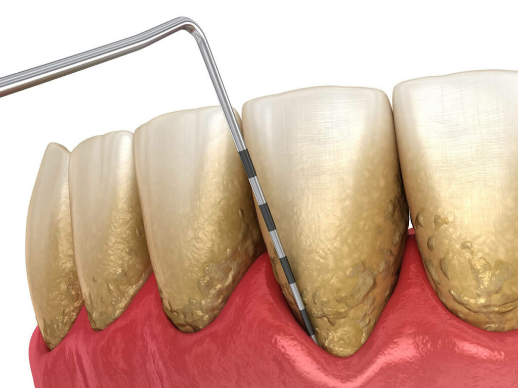 gum disease measuring tool