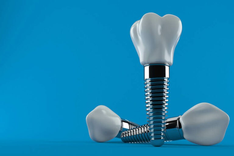Three dental implants placed on a blue background. Each implant consists of a titanium screw and a ceramic crown, illustrating the components used in dental implant procedures to replace missing teeth.