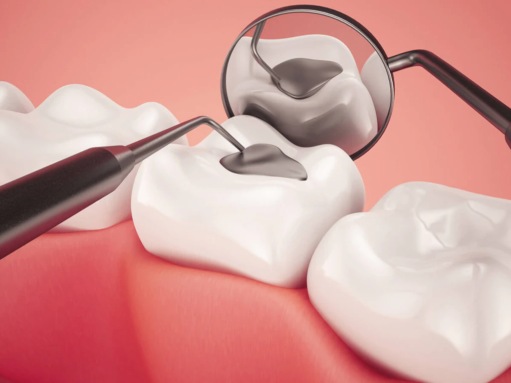 Tooth fillings and sealants available at Endres Dental Care in Burtonsville, MD