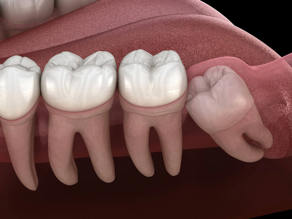Wisdom teeth removals at Endres Dental Care in Burtonsville, MD