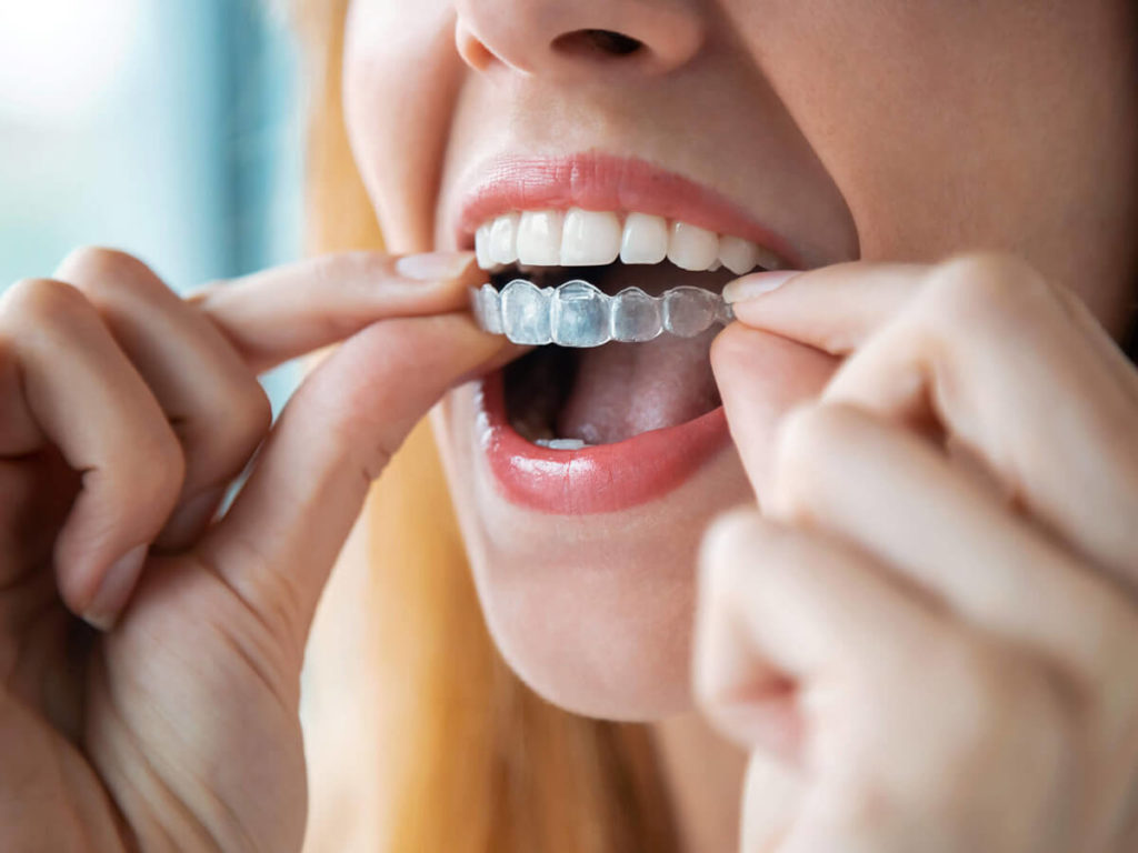 woman putting in a clear aligner