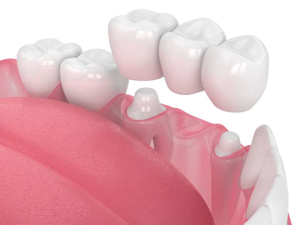 Dental bridges at Endres Dental Care in Burtonsville, MD