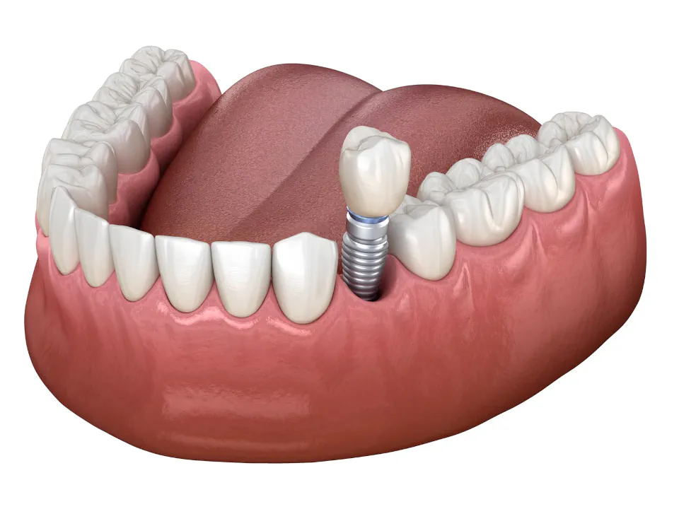 Dental Implants at Endres Dental Care in Burtonsville, MD