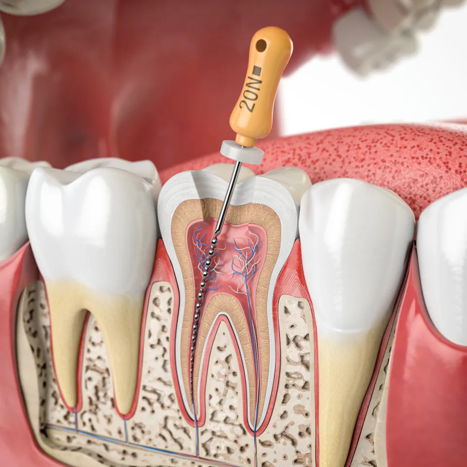 Root canal procedures performed at Endres Dental Care in Burtonsville, MD