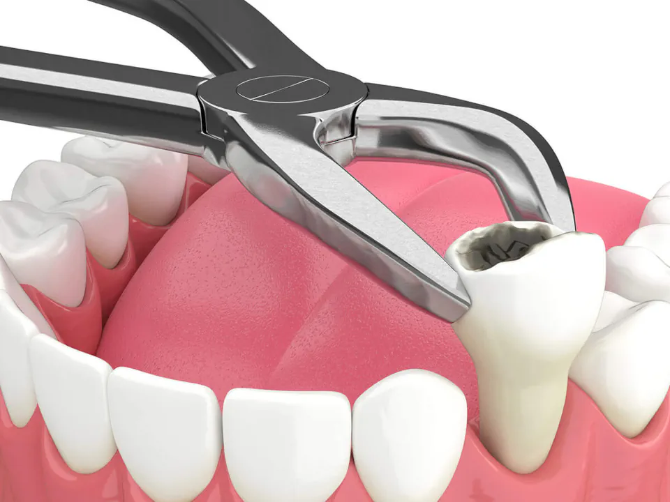 Tooth Extraction services at Endres Dental Care in Burtonsville, MD