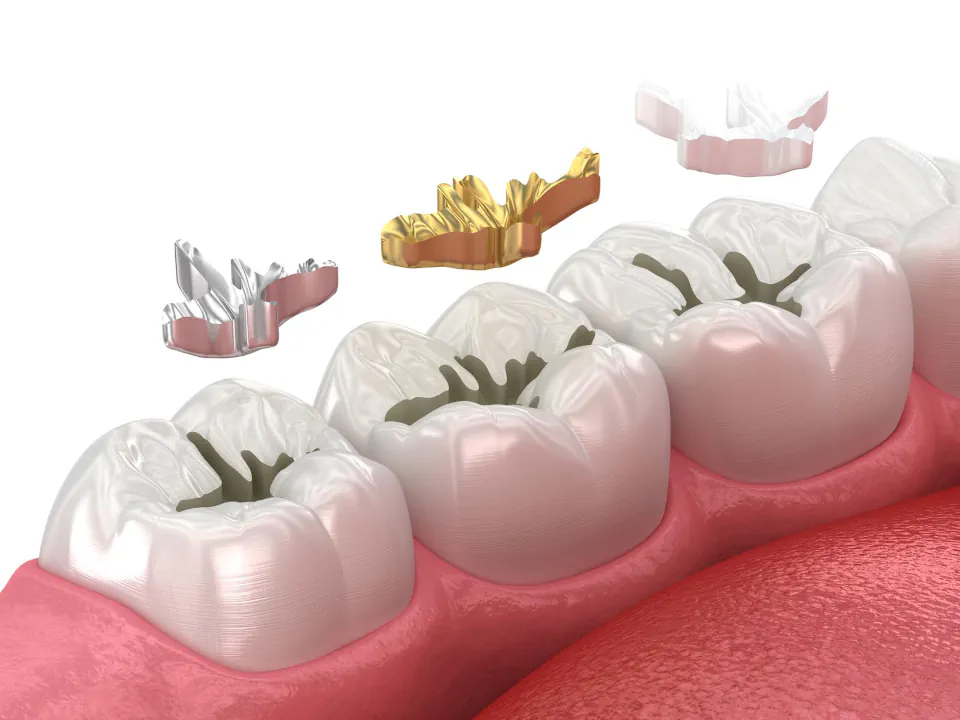 Dental Fillings at Endres Dental Care in Burtonsville, MD